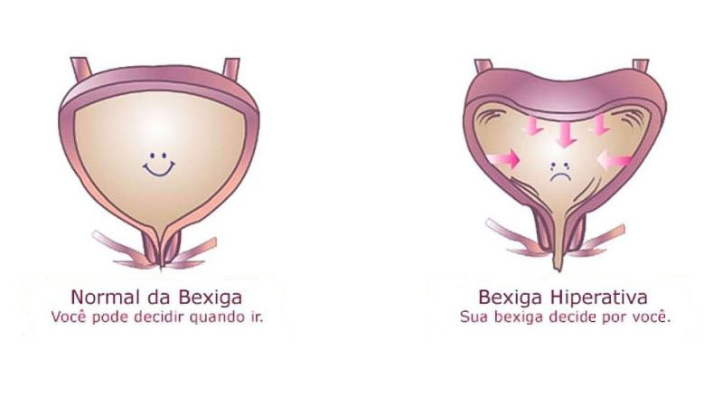 Bexiga Hiperativa